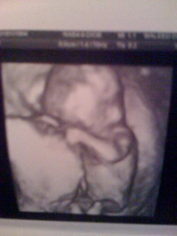 Addison in Womb